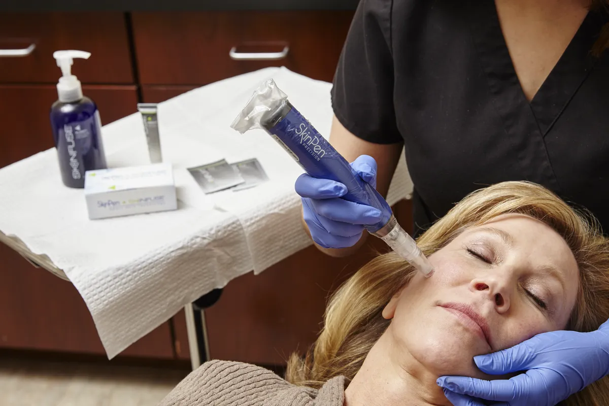 From Summer Sun to Smooth Skin: The Power of Microneedling